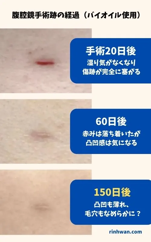 バイオイルの傷跡への効果