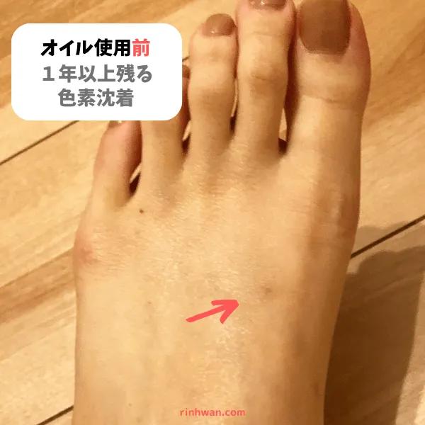 バイオイルの効果 ニキビ跡・色素沈着